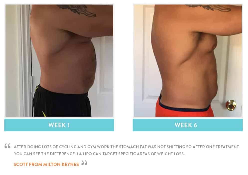Before & After Stomach Fat Hounslow
