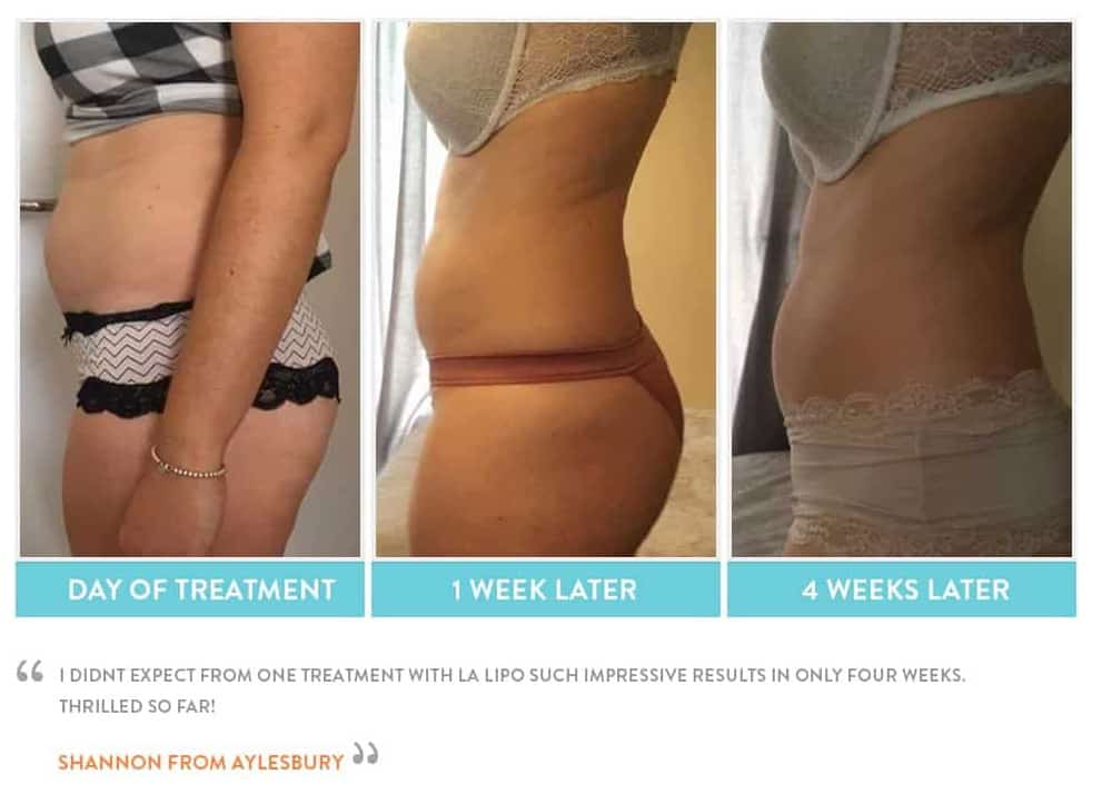before, Cryolipolysis Hounslow