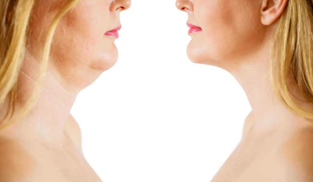Double Chin treatment Hounslow before and after results
