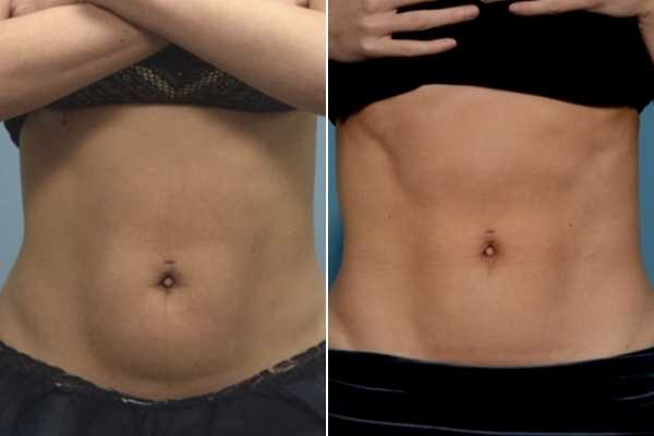 body sculpting FAQs Hounslow