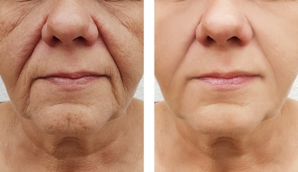 Learn more about Morpheus8 Treatment Hounslow today!