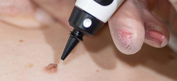After Skin Tag Removal Hounslow