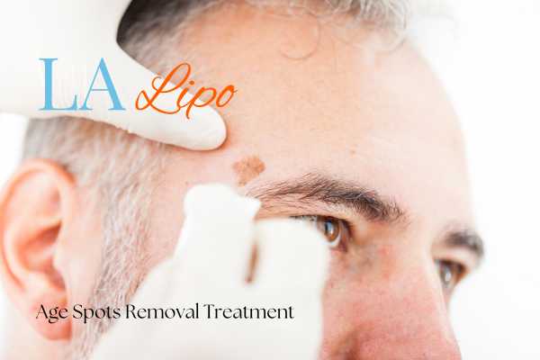 What Are the Most Effective Treatments for Age Spots Hounslow?