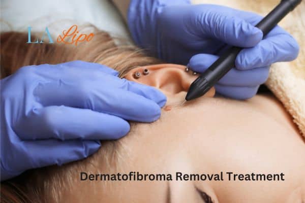 Dermatofibroma Removal Treatment Hounslow