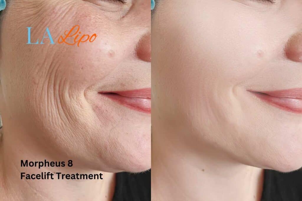 Morpheus8 Treatment Hounslow for flawless skin! Call us today!
