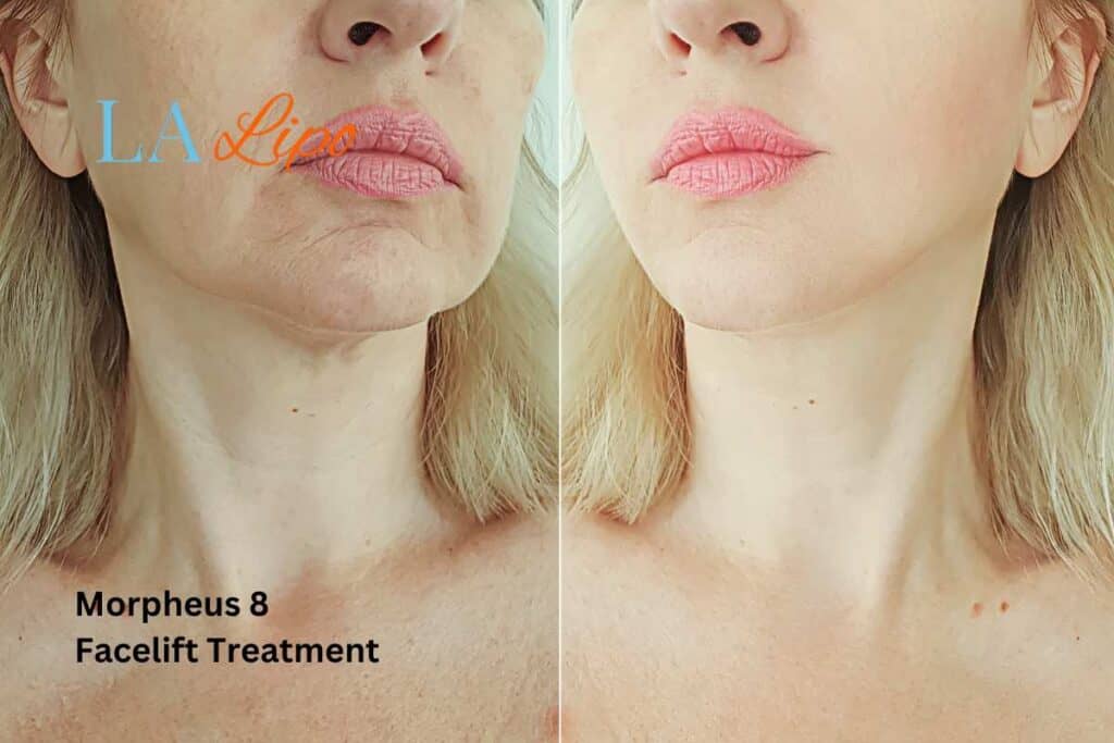 Turn back time with Morpheus8 Treatment Hounslow