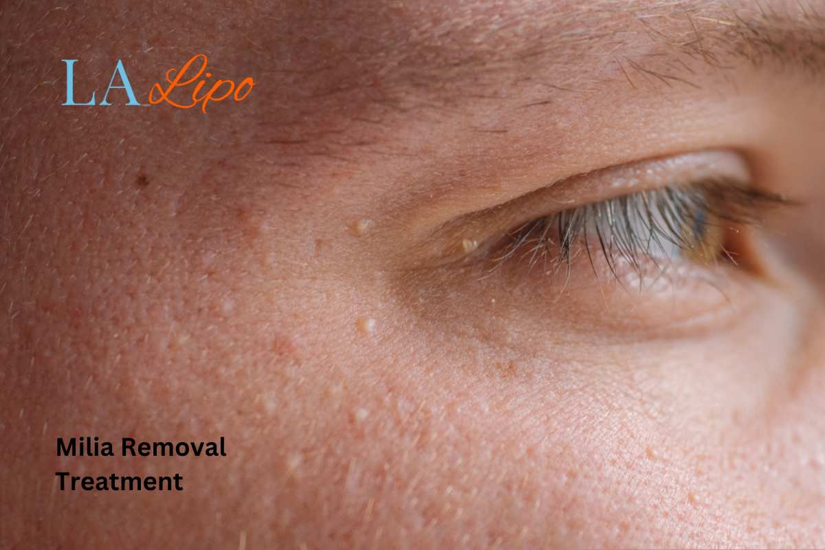 Cryopen Milia Removal: Is It the Easiest and Safest Option Hounslow?