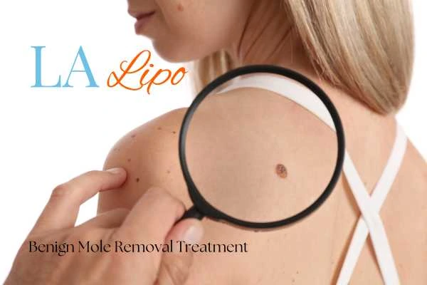 Woman having her inspection of blemish before mole removal Hounslow