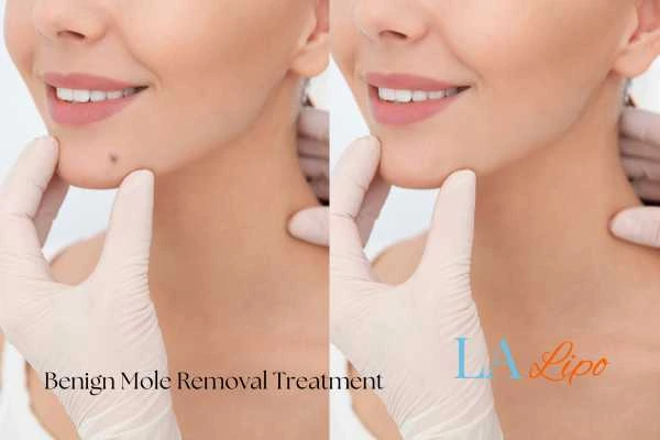 woman's before and after mole removal Hounslow results