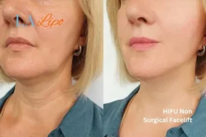 hi-fu for wrinkles Hounslow before and after results