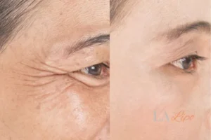 Before and after results of woman - HI-fu wrinkles reduction treatment Hounslow