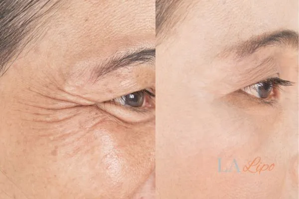 Before and after results of woman - HI-fu wrinkles reduction treatment Hounslow