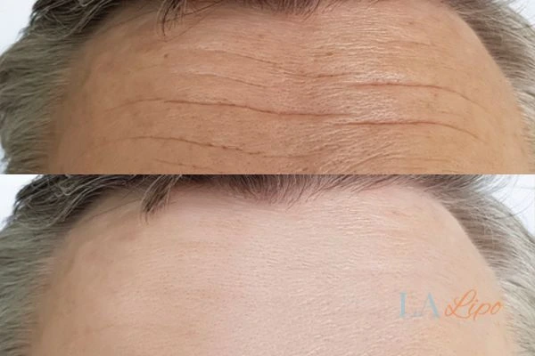 results of HIFU Hounslow on mans forehead to help reduce lines and wrinkles