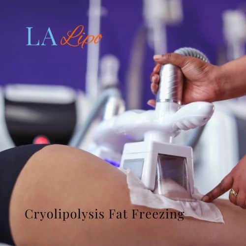fat freezing - Cryolipolysis Hounslow