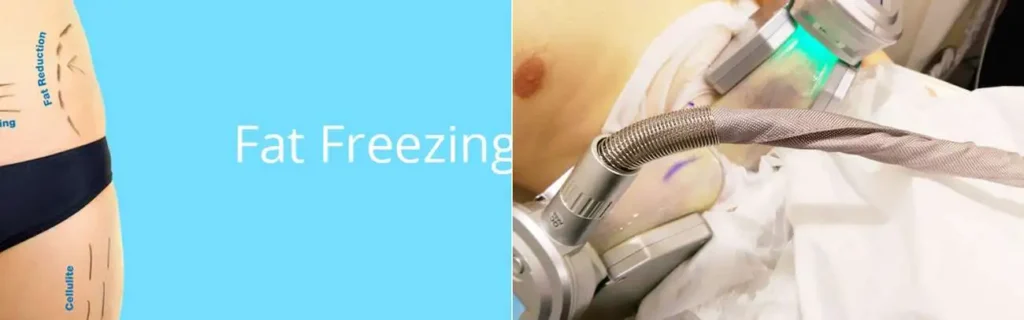 Fat freezing Hounslow on multiple areas of the body