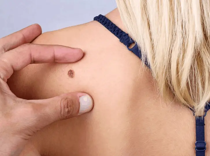 woman having mole removal Hounslow consultation before treatment.