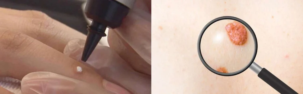 Person getting moles removed with cryopen Hounslow