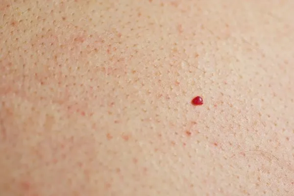 close up of a cherry angioma Hounslow