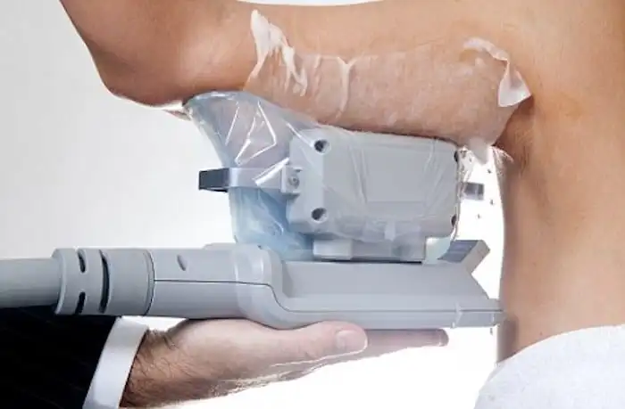 Picture of fat freezing Hounslow on the upper arms.
