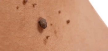image of a skin tag Hounslow