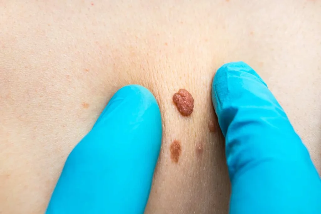 Consultant examining a skin tag Hounslow
