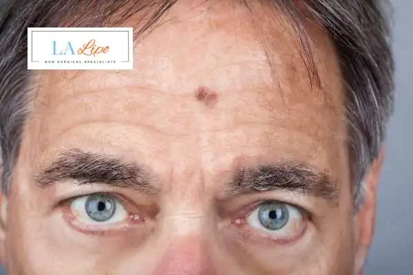 Solar Lentigo Removal Hounslow image of man with mark on his forehead