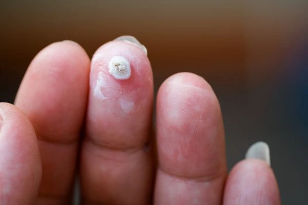 wart on person finger - cryotherapy to treat from LA LIPO Hounslow
