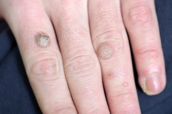 photo of warts on person hand - see wart removal Hounslow from LA LIPO