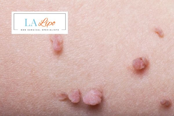 Does cryopen skin tag removal Hounslow hurt? Find out now call our team today!