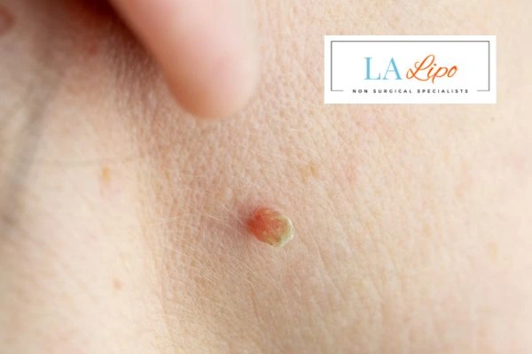 Book skin tag removal Hounslow today speak to our team now!