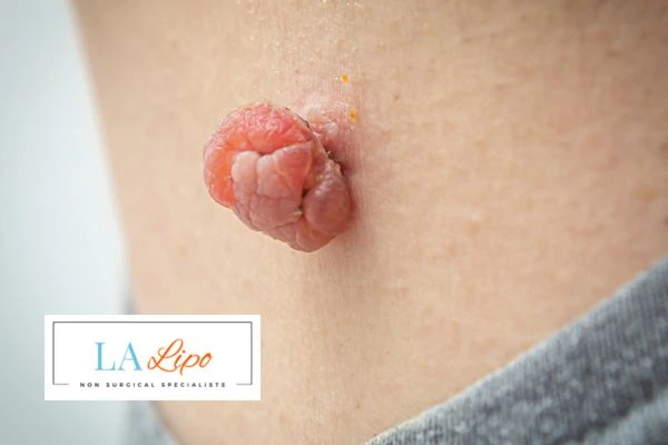 Interested in skin tag removal Hounslow? Concerned about the pain? Find out more today!