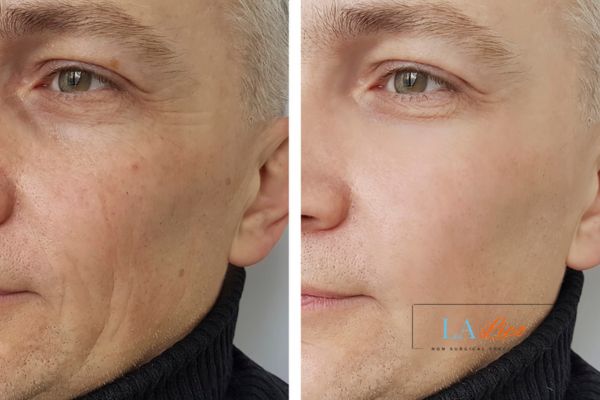 See the amazing results of Morpheus8 Treatment Hounslow!