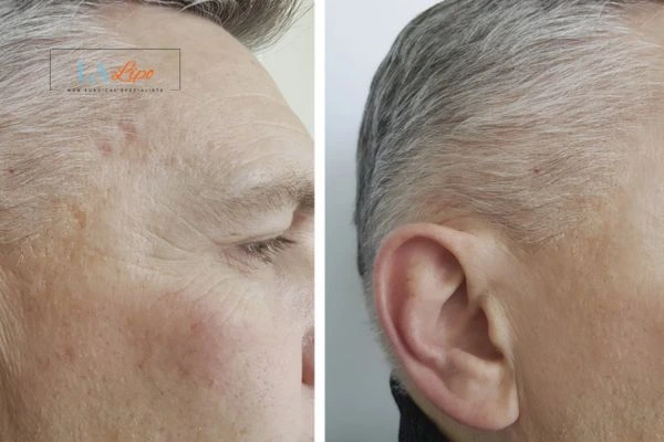 Mens Before & After Morpheus 8 Results Hounslow