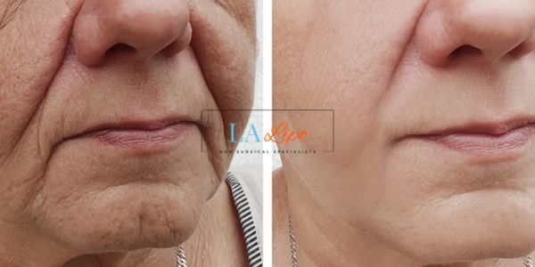 Older lady deeper wrinkle reduction - LA LIPO Morpheus 8 Results Hounslow