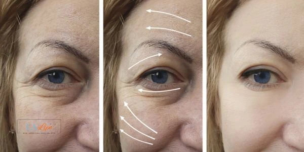 Amazing eye lift Morpheus 8 results Hounslow