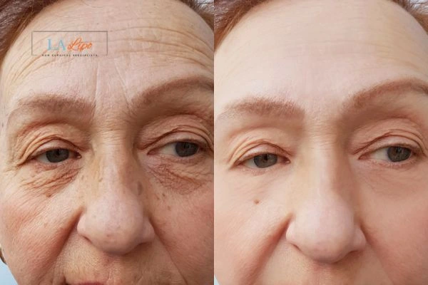 The powerful benefits of Morpheus8 Treatment Hounslow - Call Our team today!