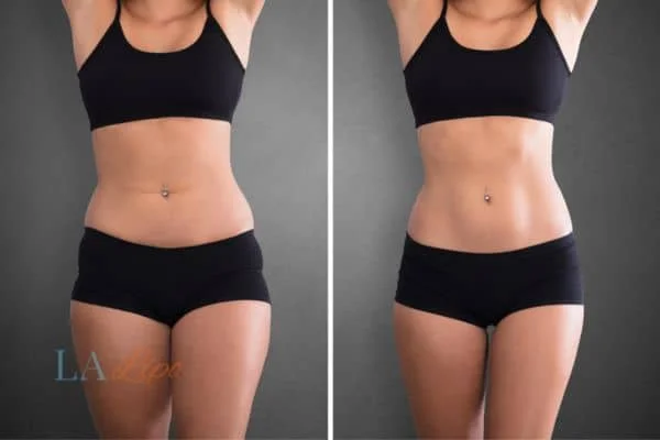 before and after results of non-surgical treatment to help a woman's body image and mental health Hounslow