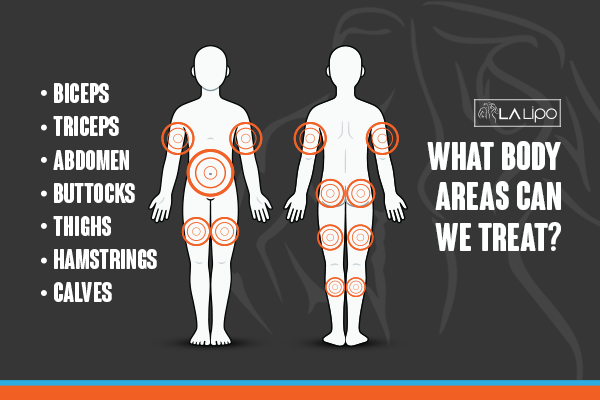 Diagram to show areas you can have LA-EMS Body Sculpting Treatment Hounslow