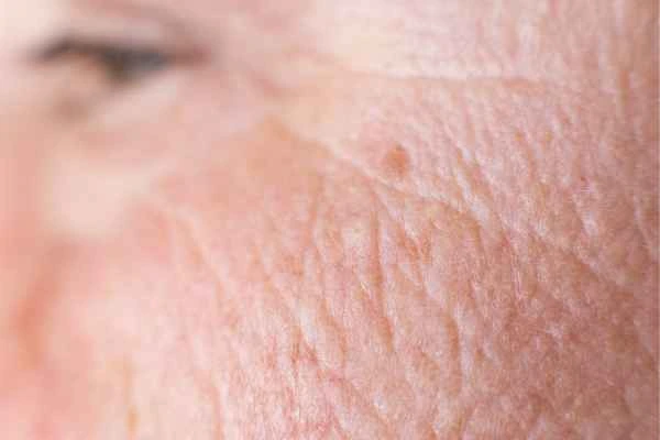 close up picture of a woman's face showing an age spot Hounslow