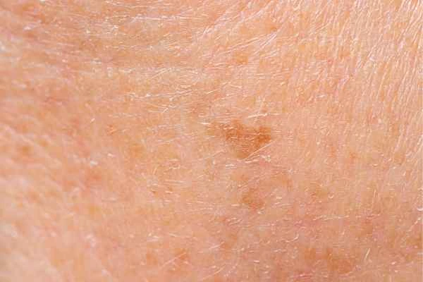 close up picture of age spots Hounslow