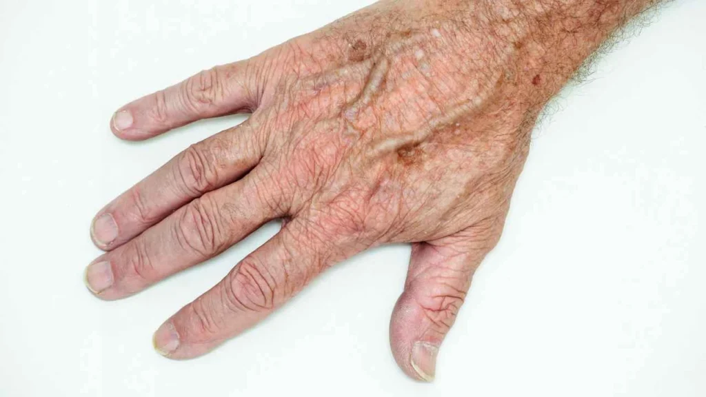 Male hand showing age spot Hounslow