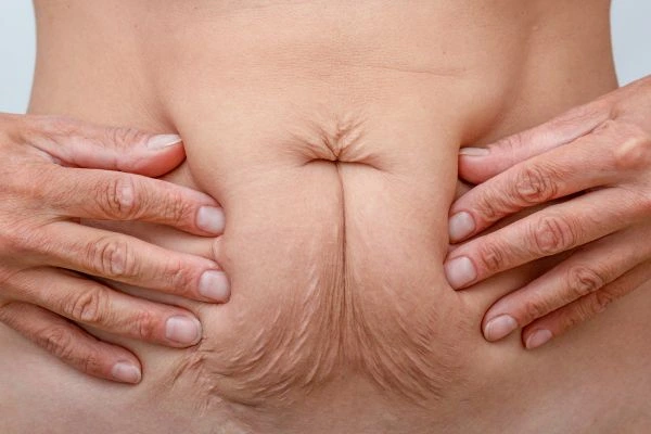 Image of a woman's stomach with loose skin - example of skin tightening Hounslow options
