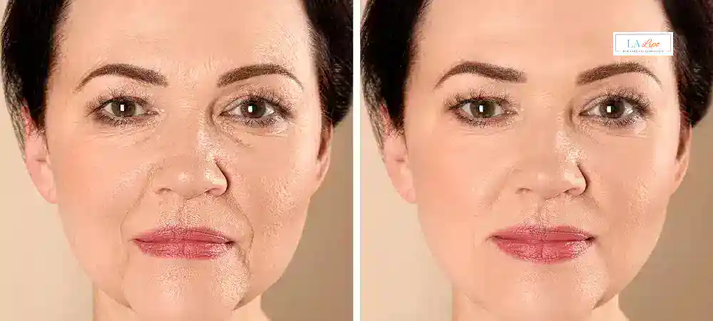 How Long Does It Take to See Results and How Long Do They Last Hounslow?