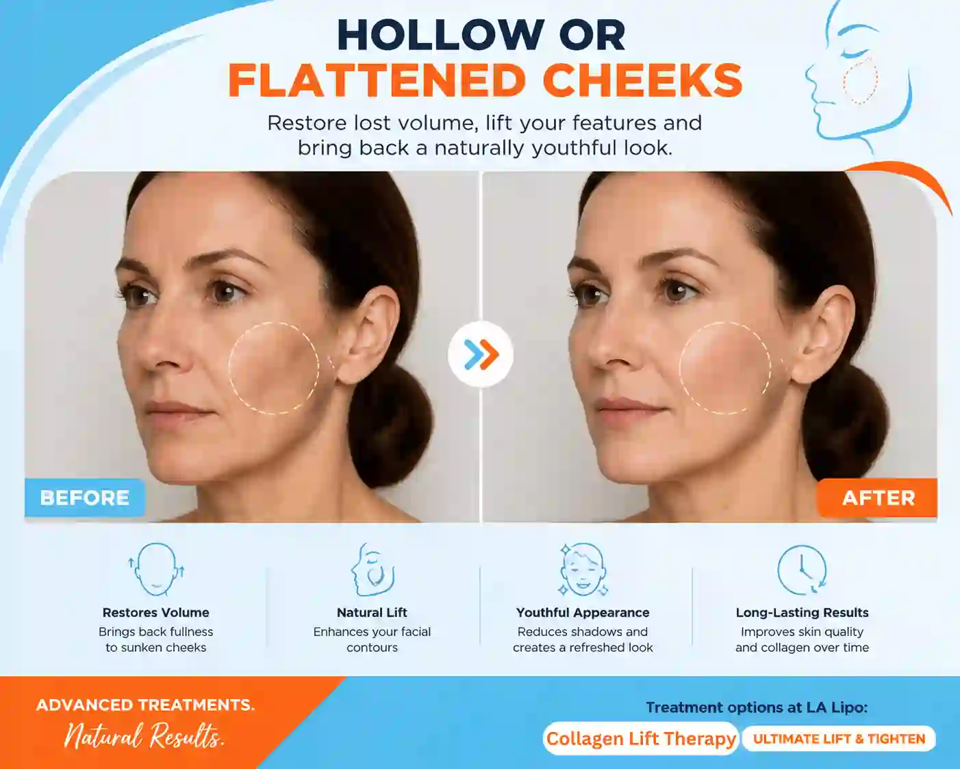 Sign #4: Hollow or Flattened Cheeks Hounslow