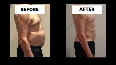 What Symptoms Can Diastasis Recti Cause in Men? Weak Core, Back Pain and Poor Posture Hounslow